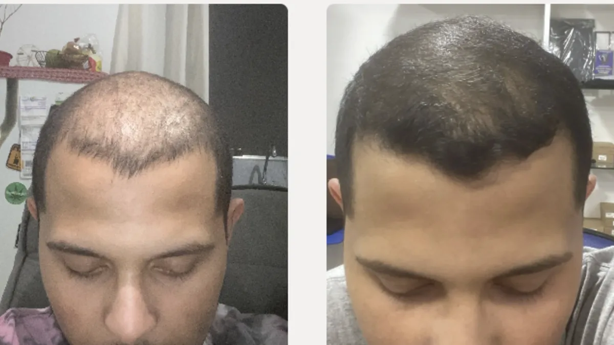 Antes e depois — paciente 1